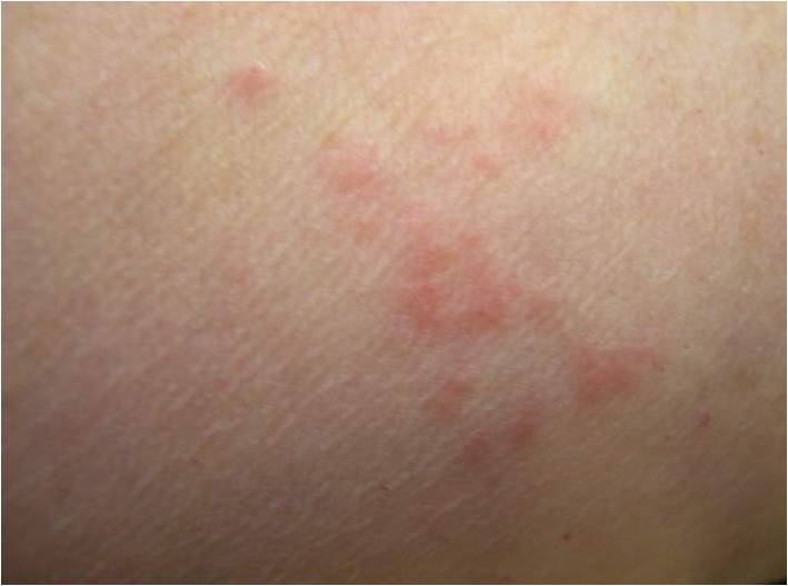 Real photograph of possible bed bug bites on a person's arm